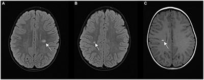 Multiple sclerosis in a 4-year-old boy: a case report and literature review